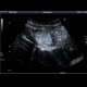 Focal nodular hyperplasia (FNH), CEUS: US - Ultrasound